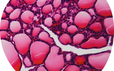 Diabetes mellitus