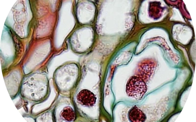 Endometriosis