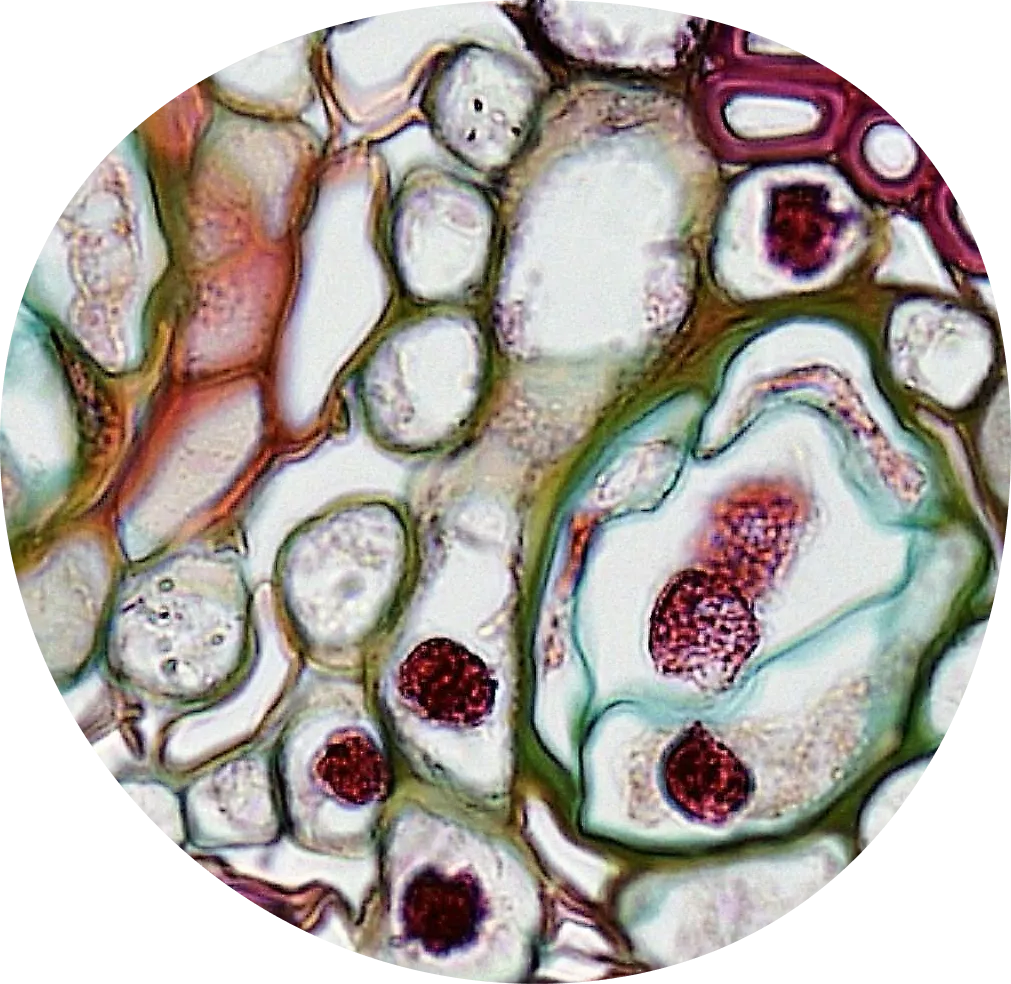 Endometriosis