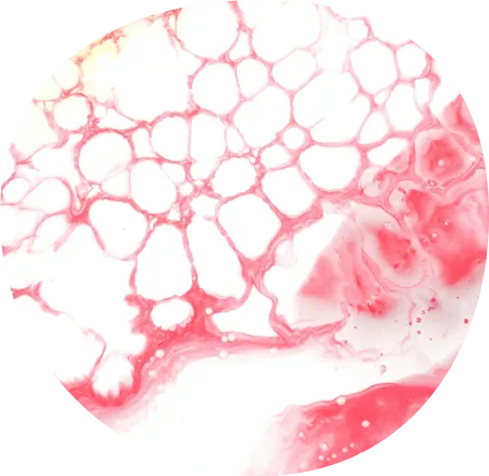 Folic-acid-deficiency-anemia-Folsauremangel-Anamie