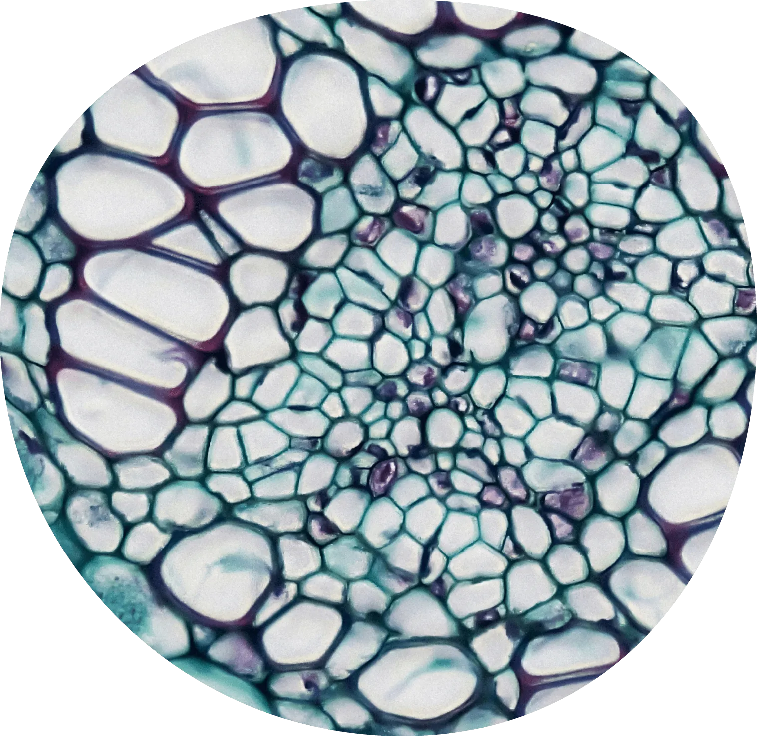 Gonorrhea