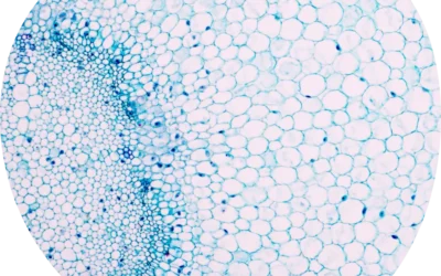 Hashimoto’s thyroiditis
