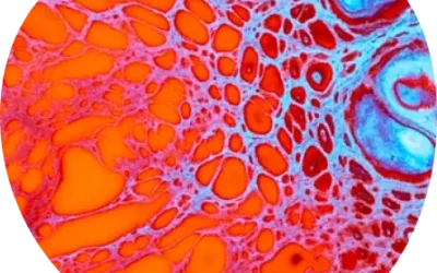 Hyperprolactinemia with suspected prolactinoma