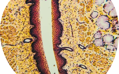Severe hyperandrogenemia