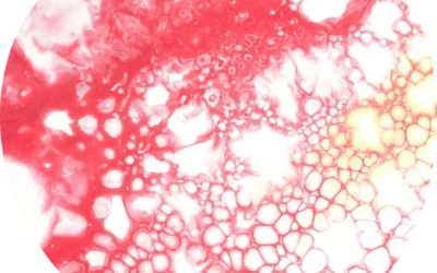 Vitamin B12 Deficiency
