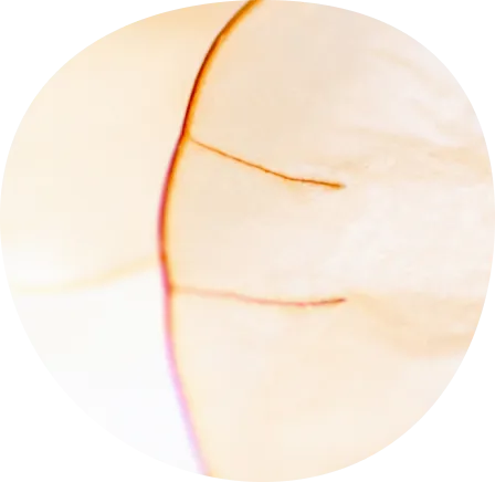 Vitamin-D-Mangel-Vitamin-D-deficiency-1