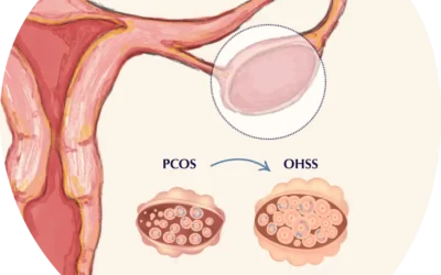 Ovarian Hyperstimulation Syndrome (OHSS)